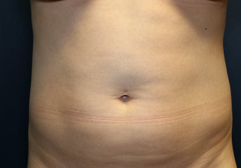 Liposuction Before & After Gallery - Patient 481624 - Image 1