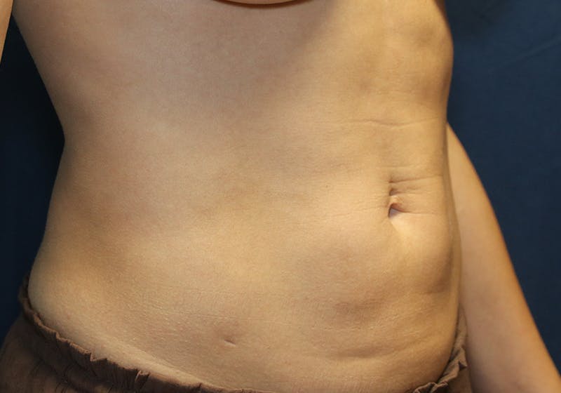 Liposuction Before & After Gallery - Patient 481624 - Image 4