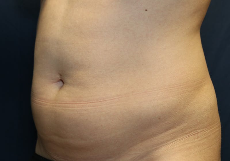 Liposuction Before & After Gallery - Patient 481624 - Image 7