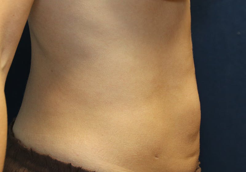 Liposuction Before & After Gallery - Patient 481624 - Image 6