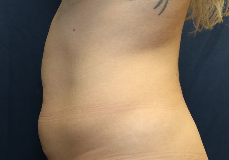 Liposuction Before & After Gallery - Patient 481624 - Image 9