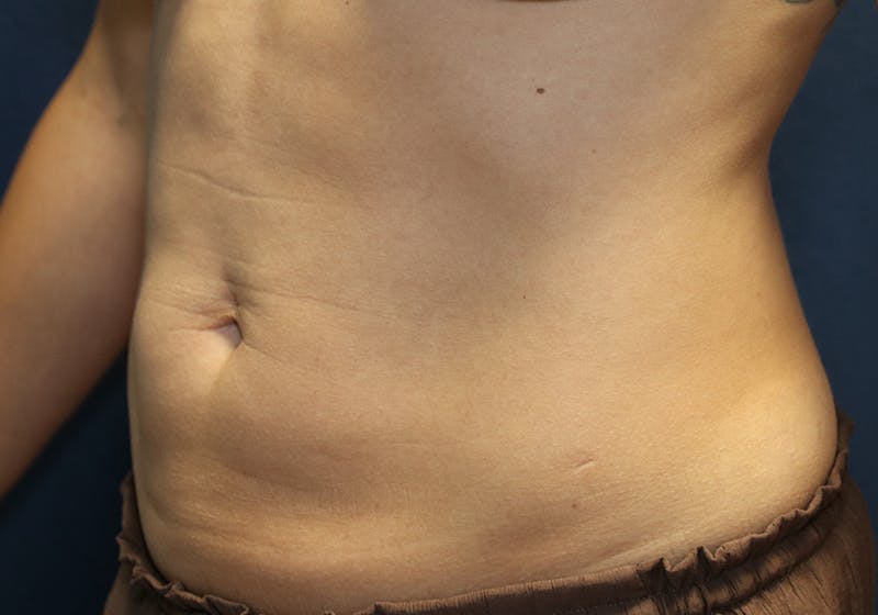 Liposuction Before & After Gallery - Patient 481624 - Image 8