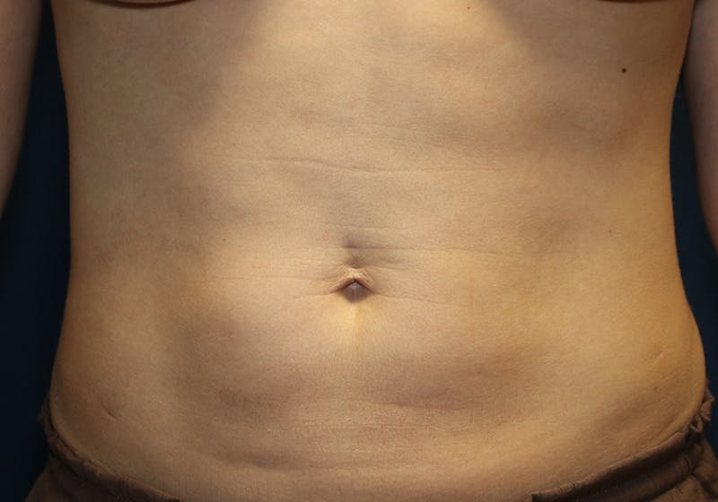 Liposuction Before & After Gallery - Patient 481624 - Image 2
