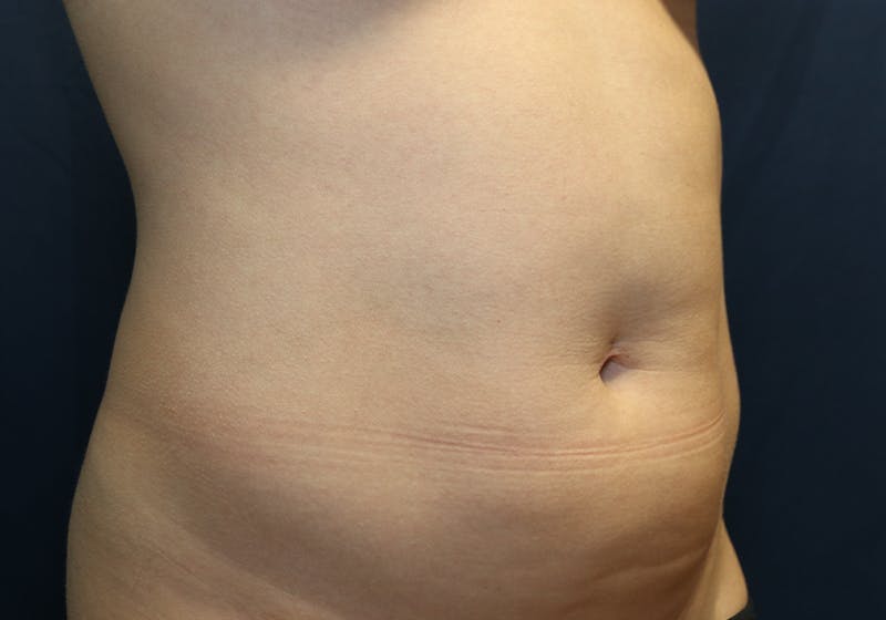Liposuction Before & After Gallery - Patient 481624 - Image 3