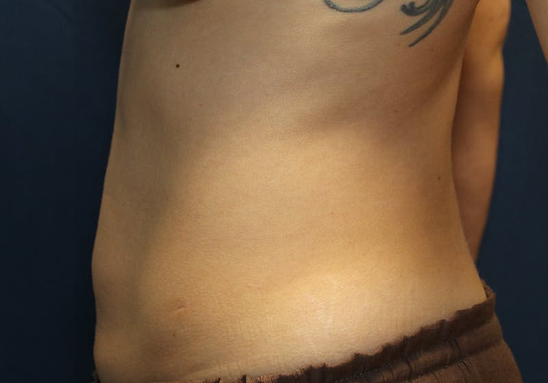 Liposuction Before & After Gallery - Patient 481624 - Image 10