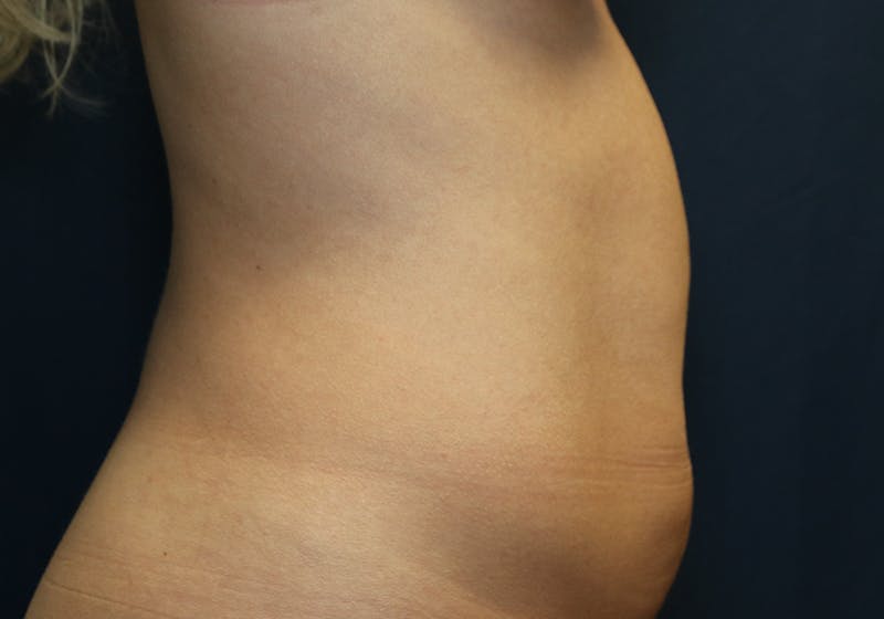 Liposuction Before & After Gallery - Patient 481624 - Image 5