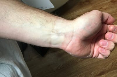 Tattoo Removal Before & After Gallery - Patient 407607 - Image 2