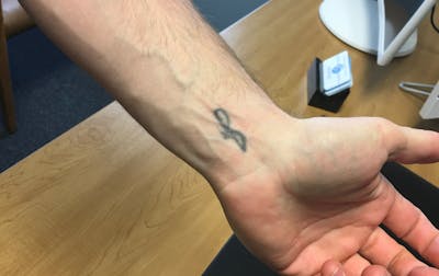 Tattoo Removal Before & After Gallery - Patient 407607 - Image 1