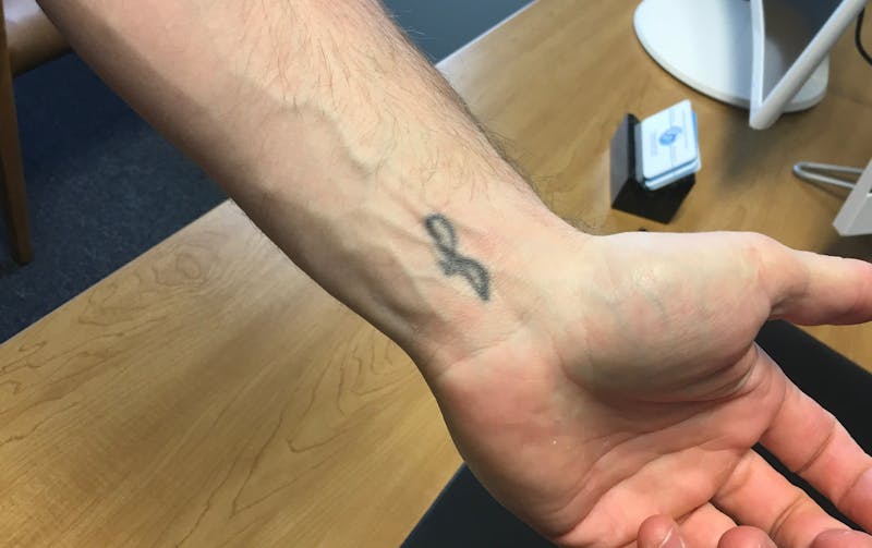 Tattoo Removal Before & After Gallery - Patient 407607 - Image 1