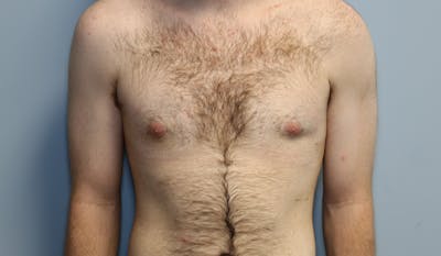 Gynecomastia Before & After Gallery - Patient 141499 - Image 2