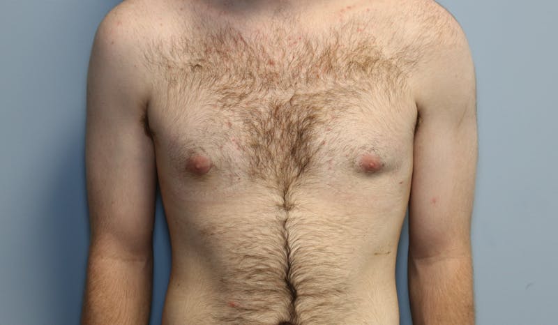 Gynecomastia Before & After Gallery - Patient 141499 - Image 2
