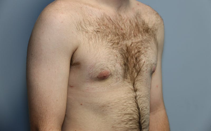 Gynecomastia Before & After Gallery - Patient 141499 - Image 4
