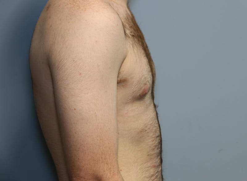 Gynecomastia Before & After Gallery - Patient 141499 - Image 10