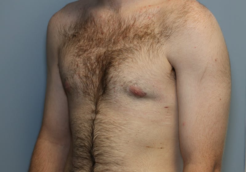 Gynecomastia Before & After Gallery - Patient 141499 - Image 6