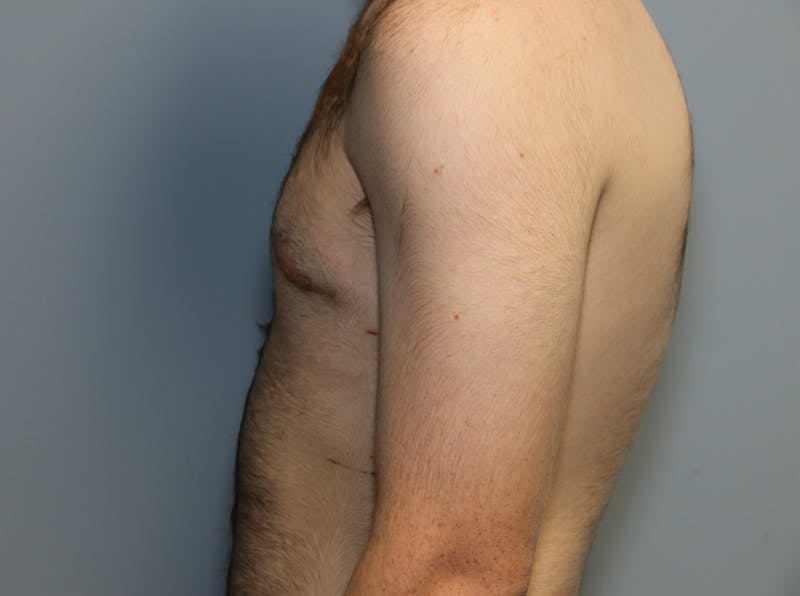 Gynecomastia Before & After Gallery - Patient 141499 - Image 8