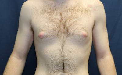 Gynecomastia Before & After Gallery - Patient 141499 - Image 1