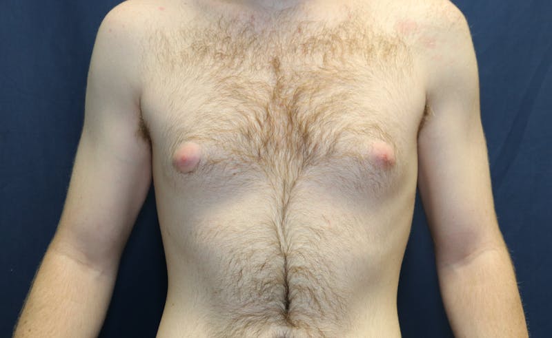 Gynecomastia Before & After Gallery - Patient 141499 - Image 1