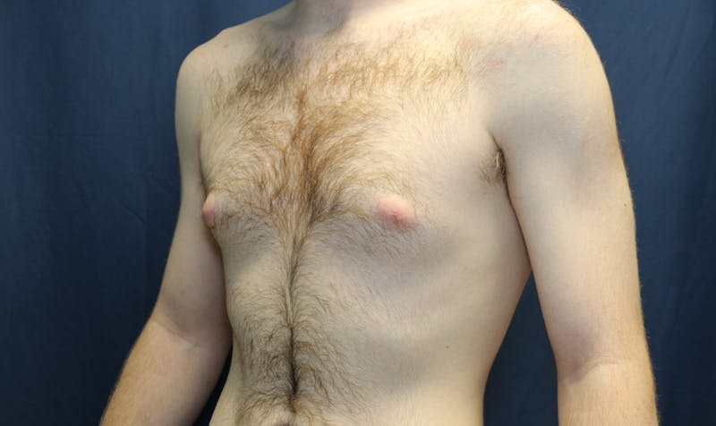 Gynecomastia Before & After Gallery - Patient 141499 - Image 5