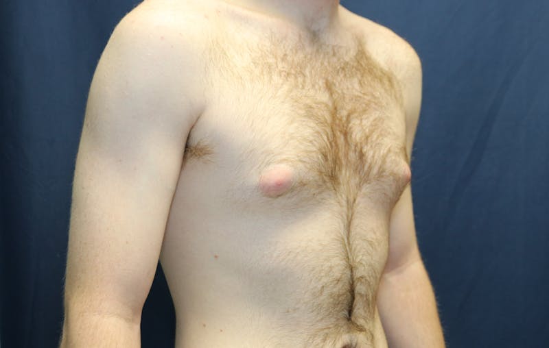Gynecomastia Before & After Gallery - Patient 141499 - Image 3