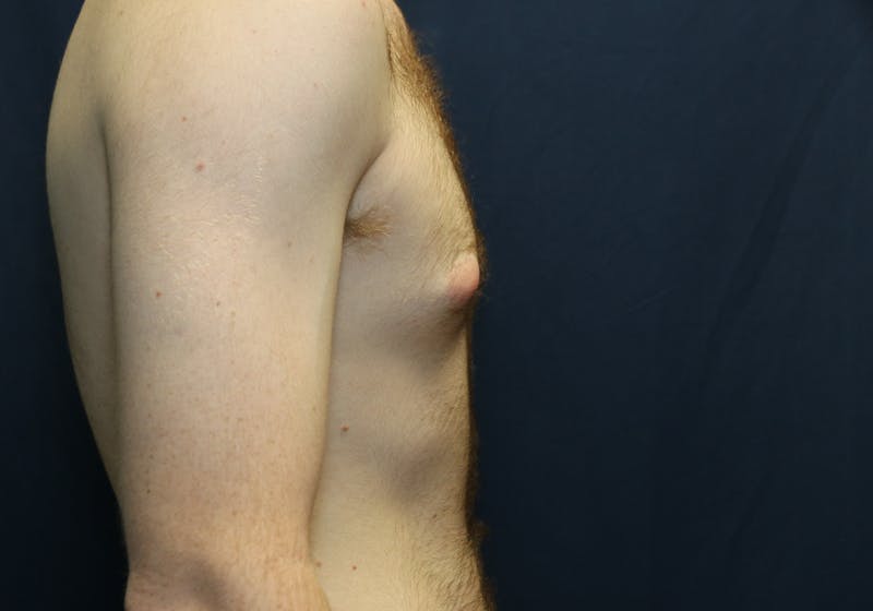 Gynecomastia Before & After Gallery - Patient 141499 - Image 9