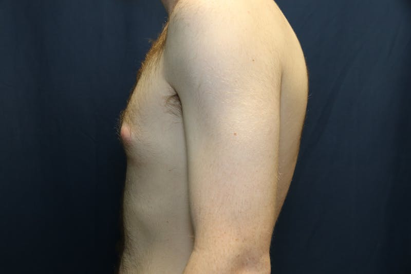 Gynecomastia Before & After Gallery - Patient 141499 - Image 7
