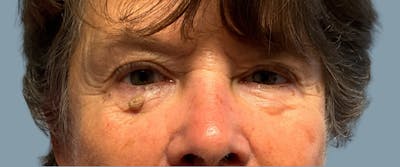 Cosmetic Lesion Removal Before & After Gallery - Patient 395134 - Image 1