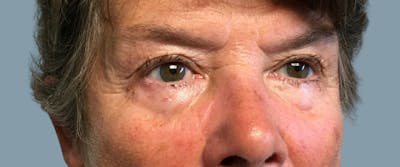 Cosmetic Lesion Removal Before & After Gallery - Patient 395134 - Image 2