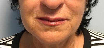 Fillers Before & After Gallery - Patient 102303 - Image 2