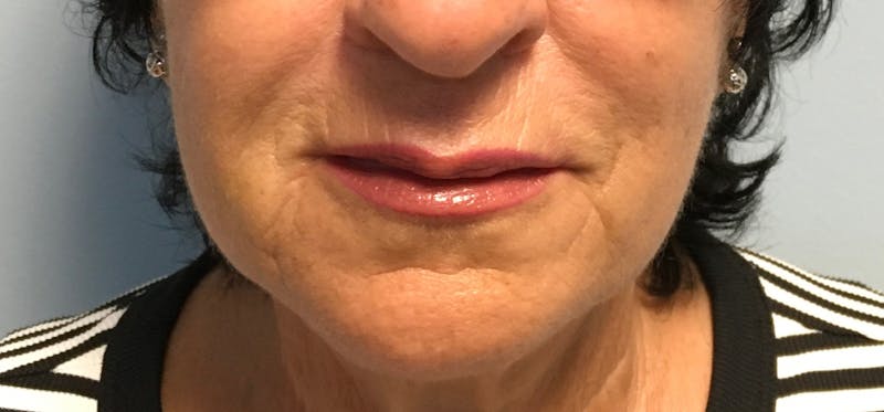 Fillers Before & After Gallery - Patient 102303 - Image 2