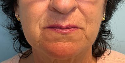 Fillers Before & After Gallery - Patient 102303 - Image 1