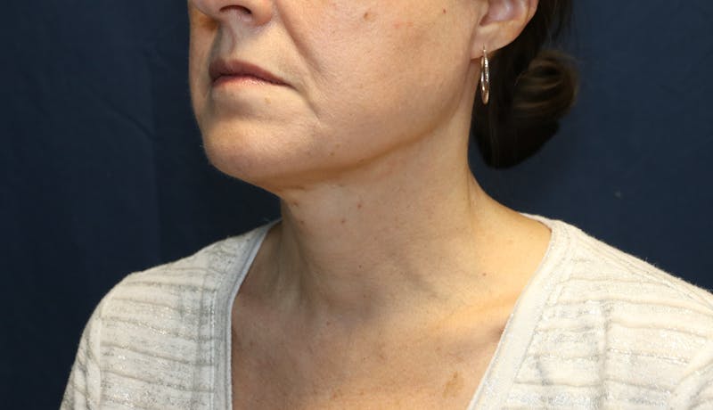 Ellevate Neck Lift Before & After Gallery - Patient 296388 - Image 4