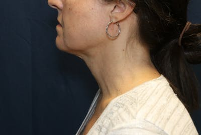 Ellevate Neck Lift Before & After Gallery - Patient 296388 - Image 2