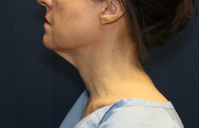 Ellevate Neck Lift Before & After Gallery - Patient 296388 - Image 1