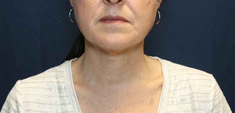Ellevate Neck Lift Before & After Gallery - Patient 296388 - Image 6