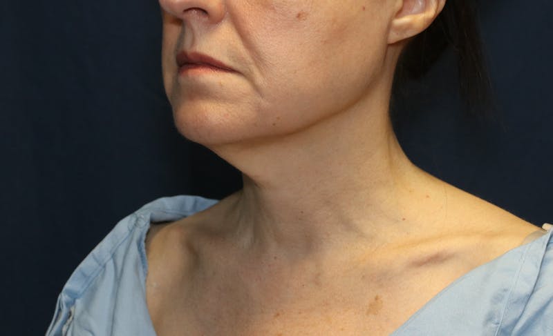 Ellevate Neck Lift Before & After Gallery - Patient 296388 - Image 3