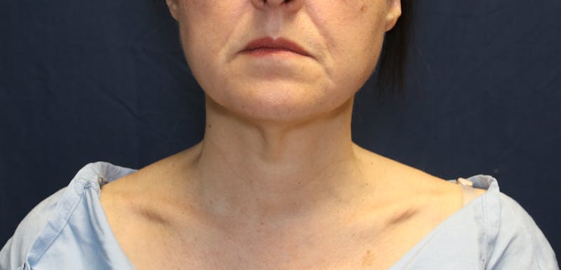 Ellevate Neck Lift Before & After Gallery - Patient 296388 - Image 5