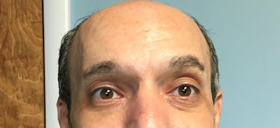 Botox Before & After Gallery - Patient 972638 - Image 2