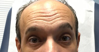 Botox Before & After Gallery - Patient 972638 - Image 1