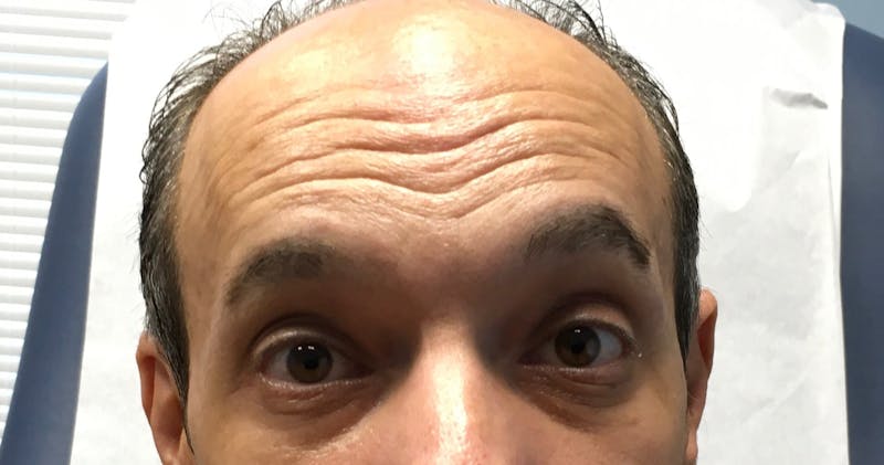 Botox Before & After Gallery - Patient 972638 - Image 1