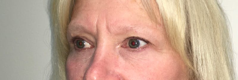Blepharoplasty (Eyelids) Before & After Gallery - Patient 305396 - Image 4