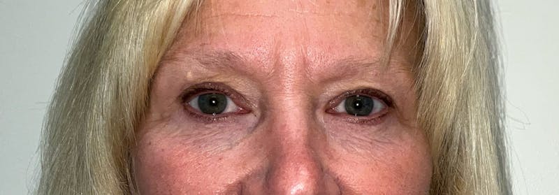 Blepharoplasty (Eyelids) Before & After Gallery - Patient 305396 - Image 2