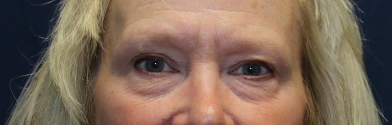 Blepharoplasty (Eyelids) Before & After Gallery - Patient 305396 - Image 1