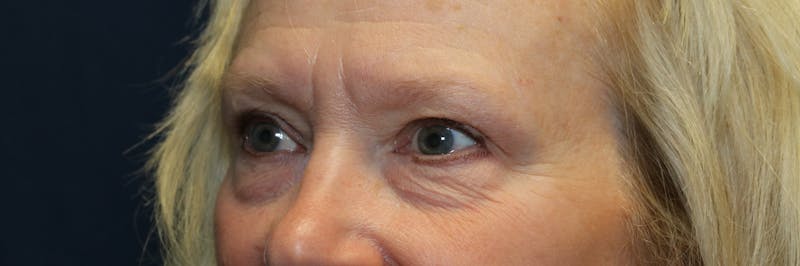 Blepharoplasty (Eyelids) Before & After Gallery - Patient 305396 - Image 3