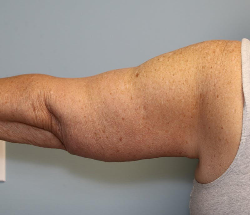 Brachioplasty (Arm Lift) Before & After Gallery - Patient 291055 - Image 4