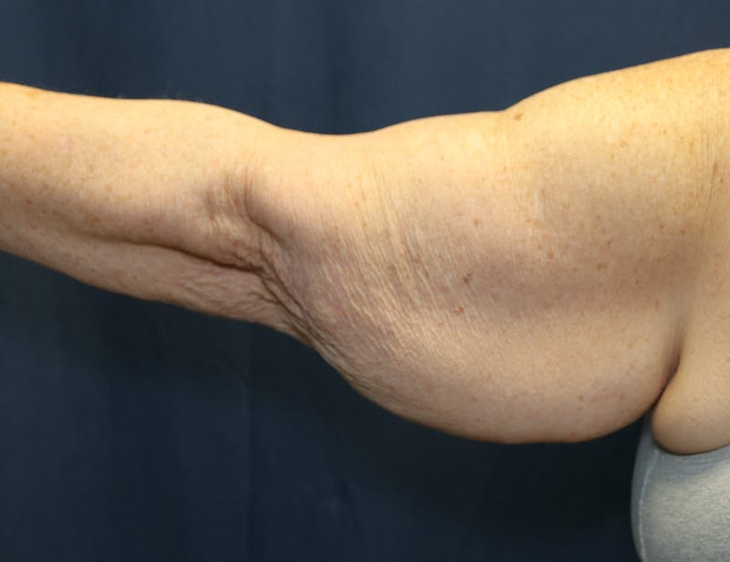 Brachioplasty (Arm Lift) Before & After Gallery - Patient 291055 - Image 3