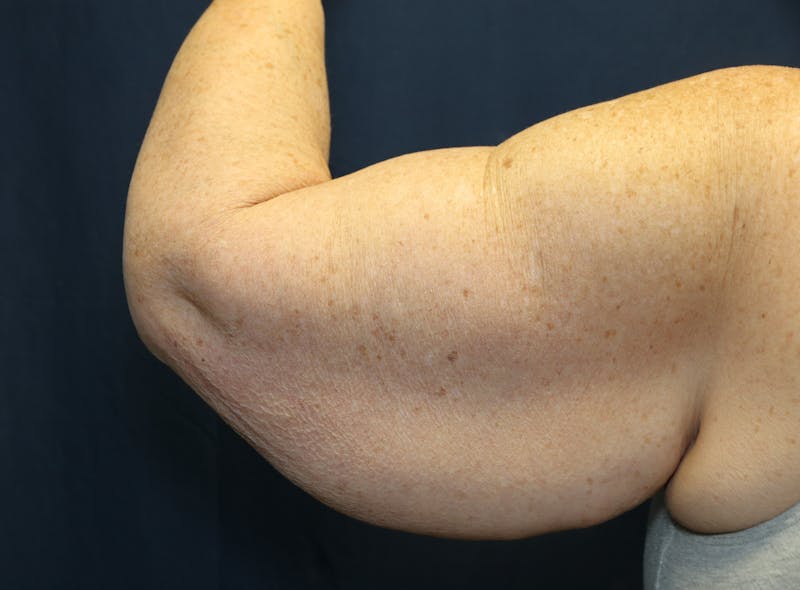 Brachioplasty (Arm Lift) Before & After Gallery - Patient 291055 - Image 5
