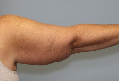 Brachioplasty (Arm Lift) Before & After Gallery - Patient 291055 - Image 2