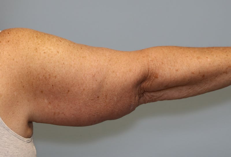 Brachioplasty (Arm Lift) Before & After Gallery - Patient 291055 - Image 2