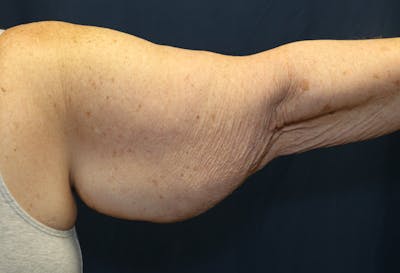 Brachioplasty (Arm Lift) Before & After Gallery - Patient 291055 - Image 1