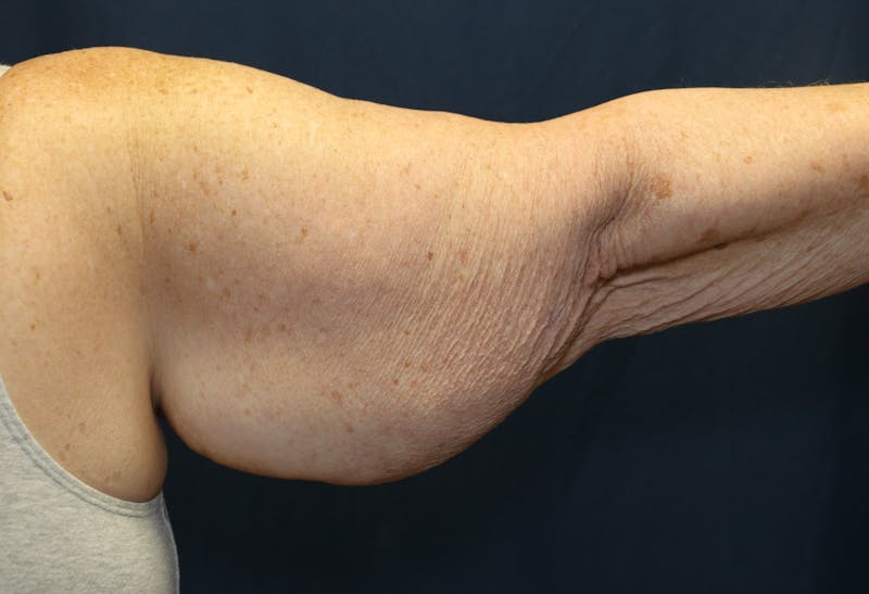 Brachioplasty (Arm Lift) Before & After Gallery - Patient 291055 - Image 1